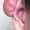 Caso 7. Inicio. Imagen de la parte superior externa de la oreja donde se observa una masa voluminosa de color rosada y superficie lisa llamada queloide