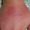 Caso 8. Imagen de cara superior de la mano, se ve la piel enrojecida y la zona inflamada por uso de relleno con biopolímeros