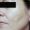 Imagen de primer plano de la piel del rostro se aprecia una mejoría del color y la superficie