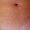 Imagen de primer plano de piel del abdomen de aprecian marcas dispuestas de forma aleatoria, delgadas de color rojizas denominadas estrías