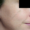Imagen del rostro con foco en la piel de la mejilla se aprecia mejoría del color y la desaparición de las manchas