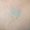 imagen de primer plano de piel en la zona del muslo en que el tatuaje ha desaparecido