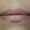 imagen de primer plano de labios en que se observa una linea mas clara alrededor de los labios después de tratamiento clínico