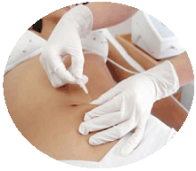 imagen de un paciente enfocando la zona del abdomen donde están realizando un procedimiento usando Carboxiterapia