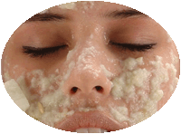Paciente a quien le están haciendo un tratamiento de peeling