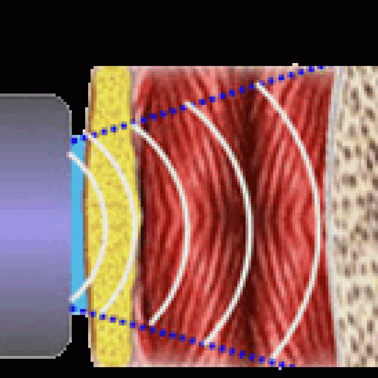 Imagen esquemática de capas de la piel siendo incididas por terapia de Bioimpedancia
