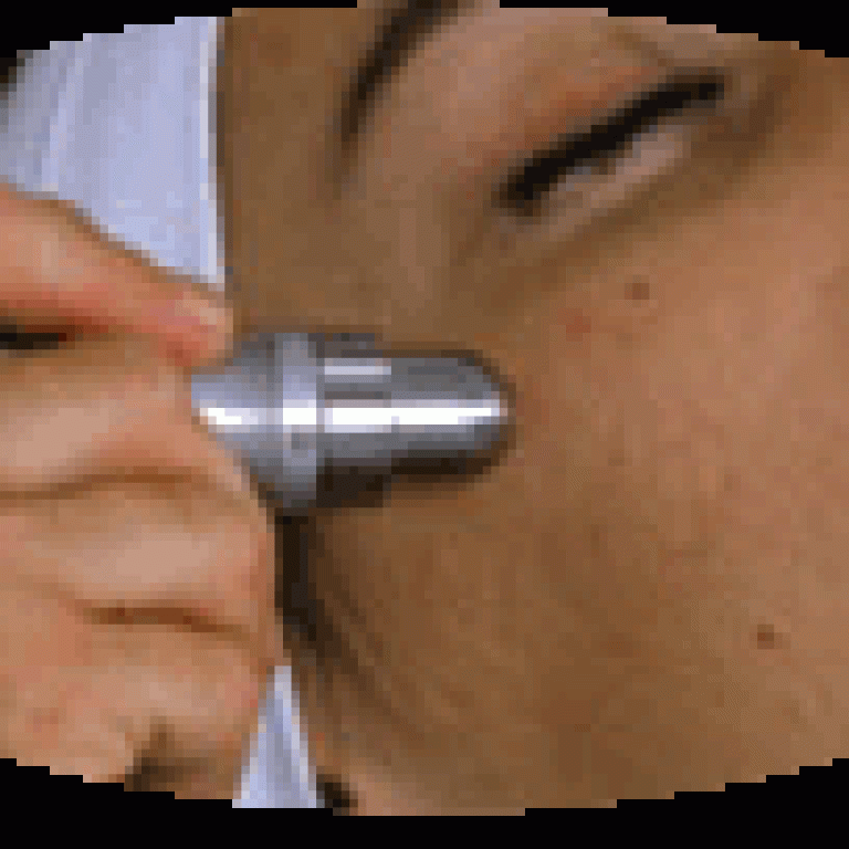 paciente recibiendo microdermabrasion