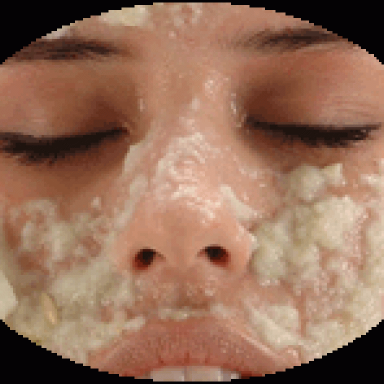 Paciente a quien le están haciendo un tratamiento de peeling